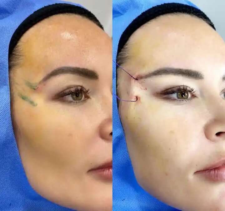 کلاهبرداری به نام «لیفت نخ»! ماجرای ترند زیبایی خطرناک‌